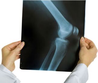 Ακτινογραφία οστεοαρθρίτιδας της άρθρωσης του γόνατος